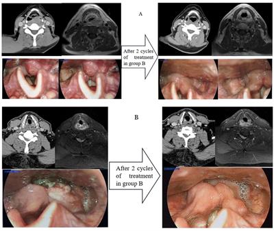 Comparison of the efficacy and safety of neoadjuvant PD-1 inhibitors plus chemotherapy vs targeted therapy plus chemotherapy in locally advanced hypopharyngeal squamous cell carcinoma